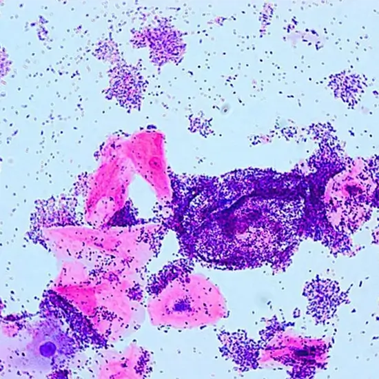 gram stain for bacterial vaginosis vaginal swab test